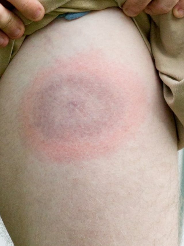 Can Lyme Disease be cured?