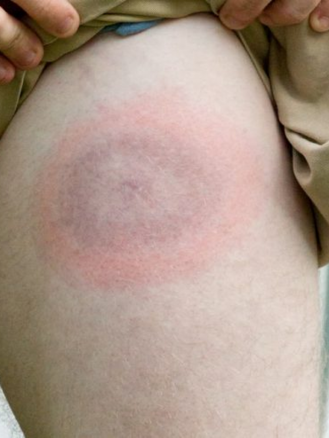 Can Lyme Disease Be Cured? LifeRx Pharmacy